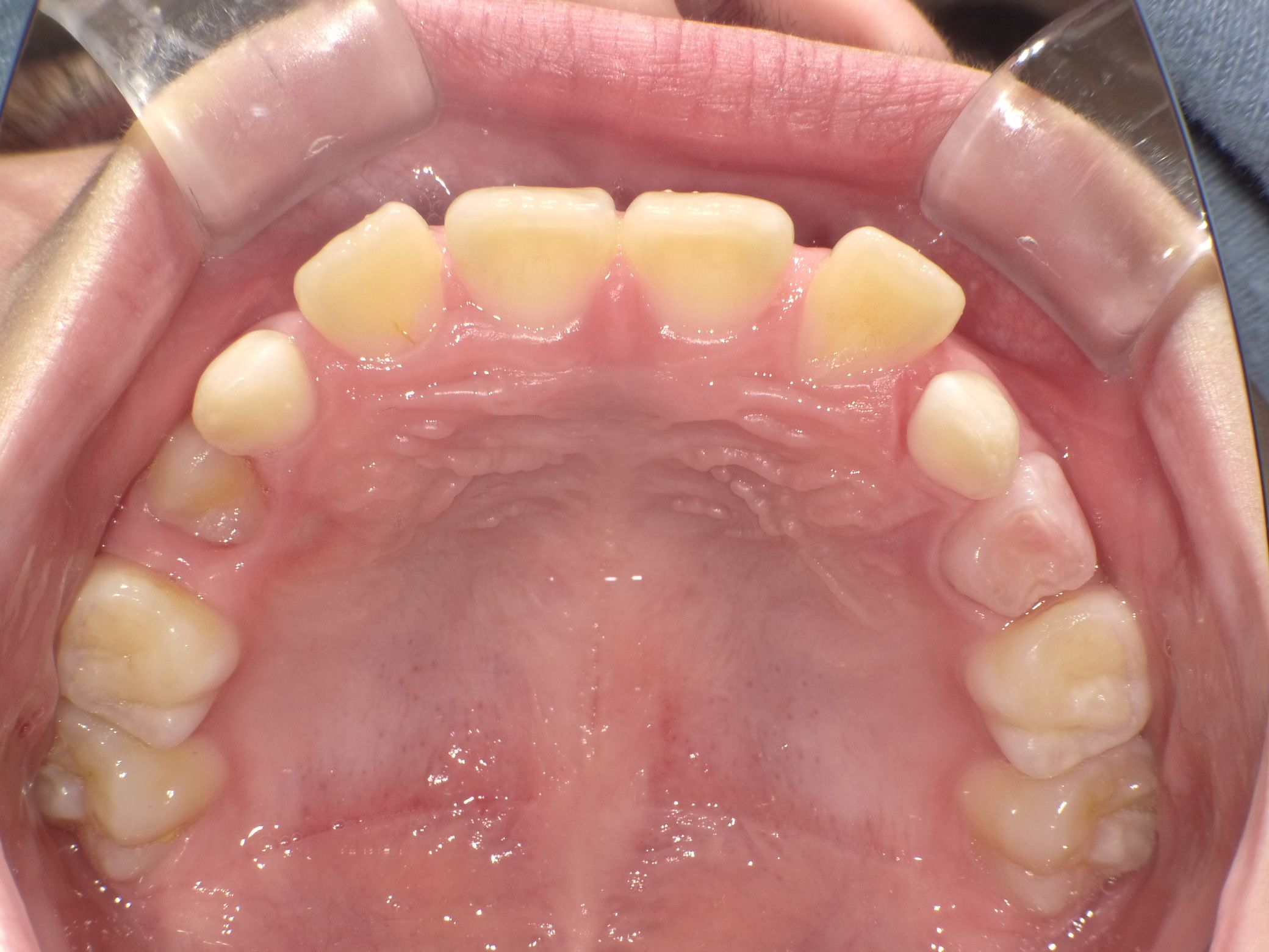 拡大されたことで四角だった歯列が改善してきた。