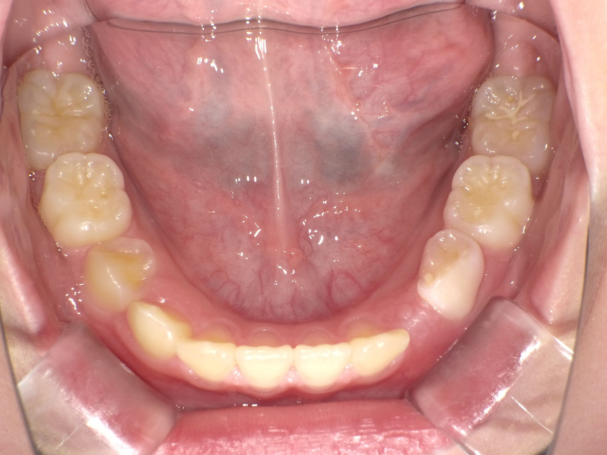 永久歯が生えるスペースが確保されてきた。