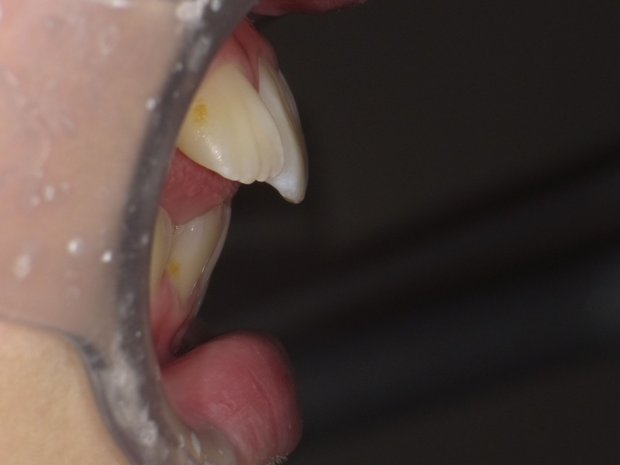 拡大したことで出っ歯になっている。