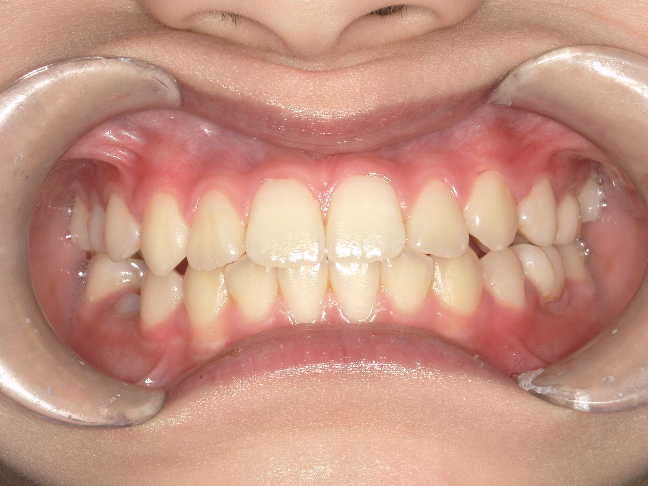 前歯のがたつきと四角い歯列が大変身！