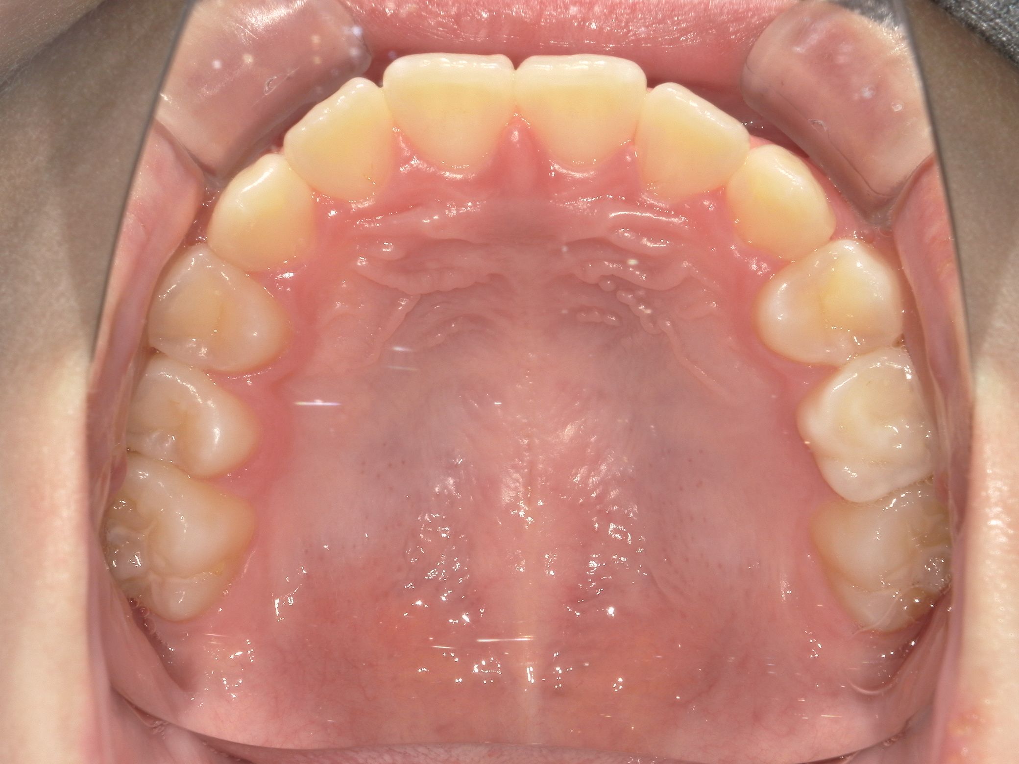 横幅が広がり、綺麗なアーチ状になった。