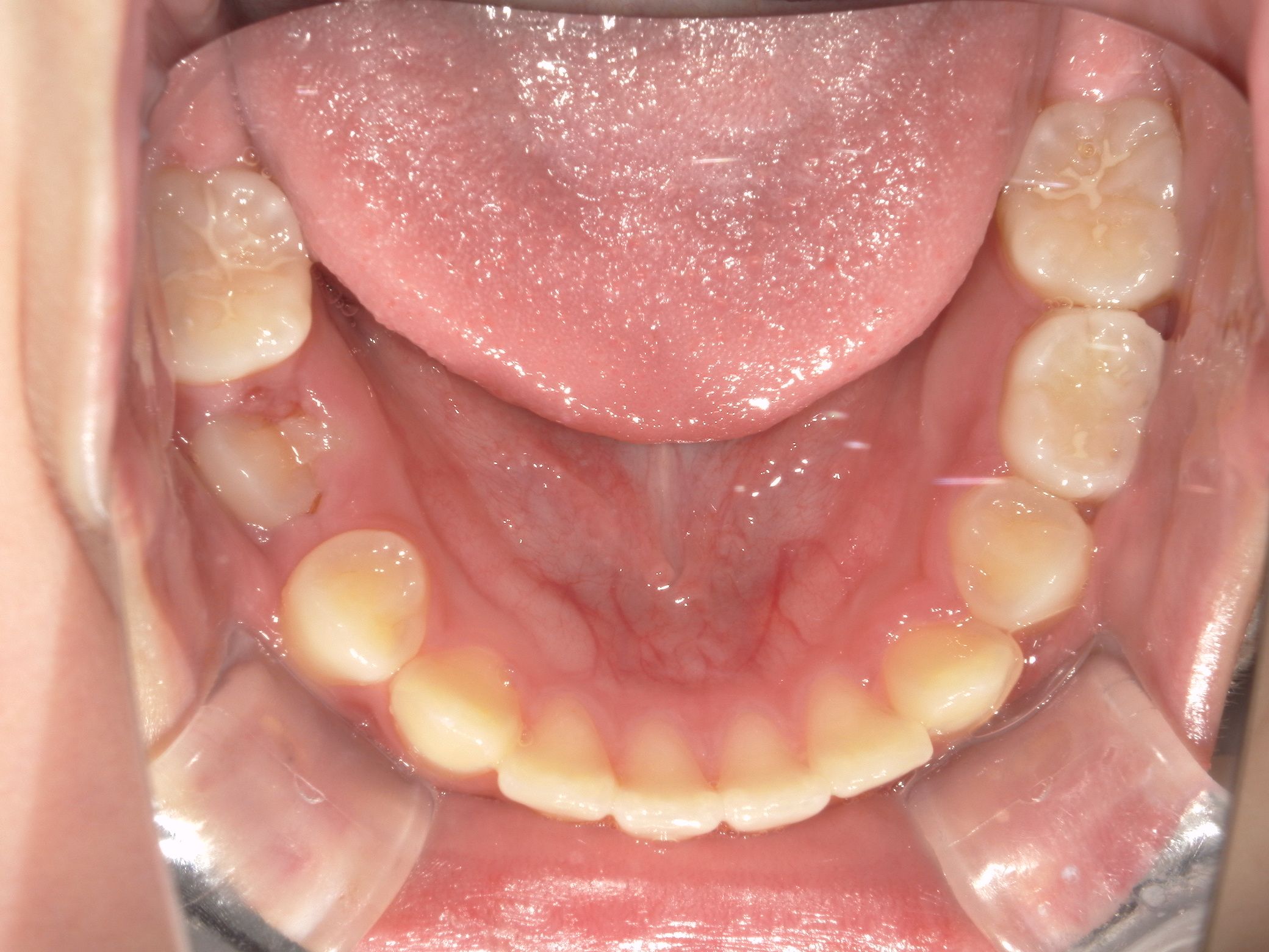 横幅が広がり、永久歯が綺麗に並んでくれた。