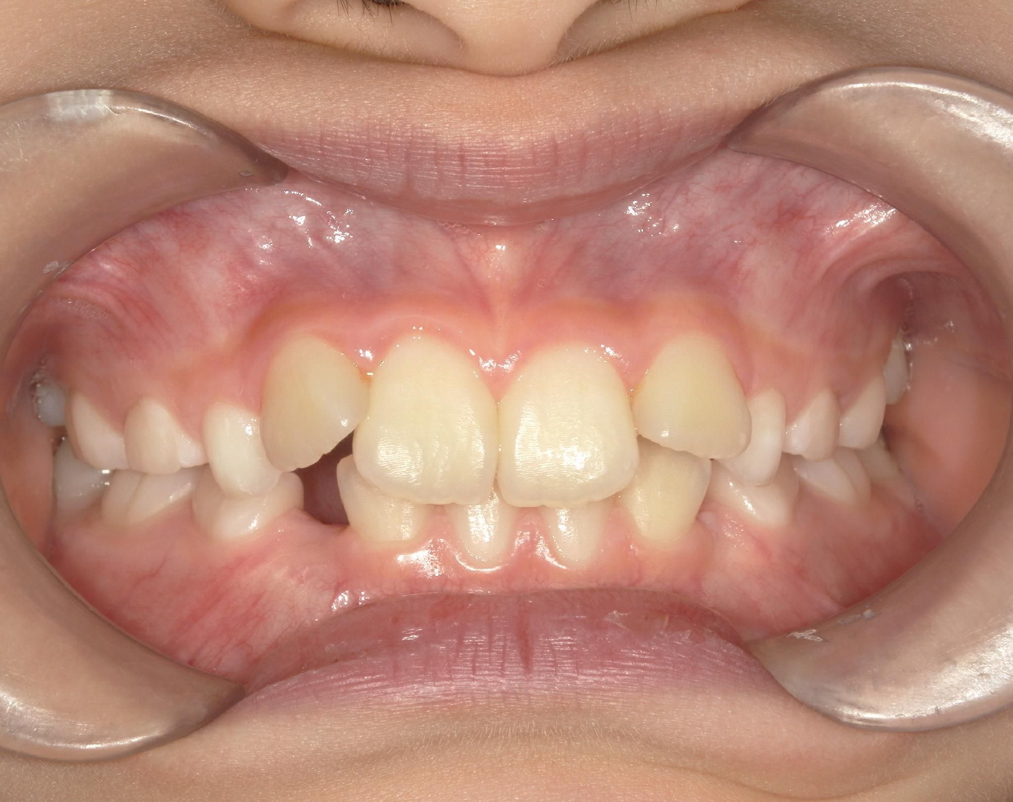 前歯のがたつきと四角い歯列が大変身！