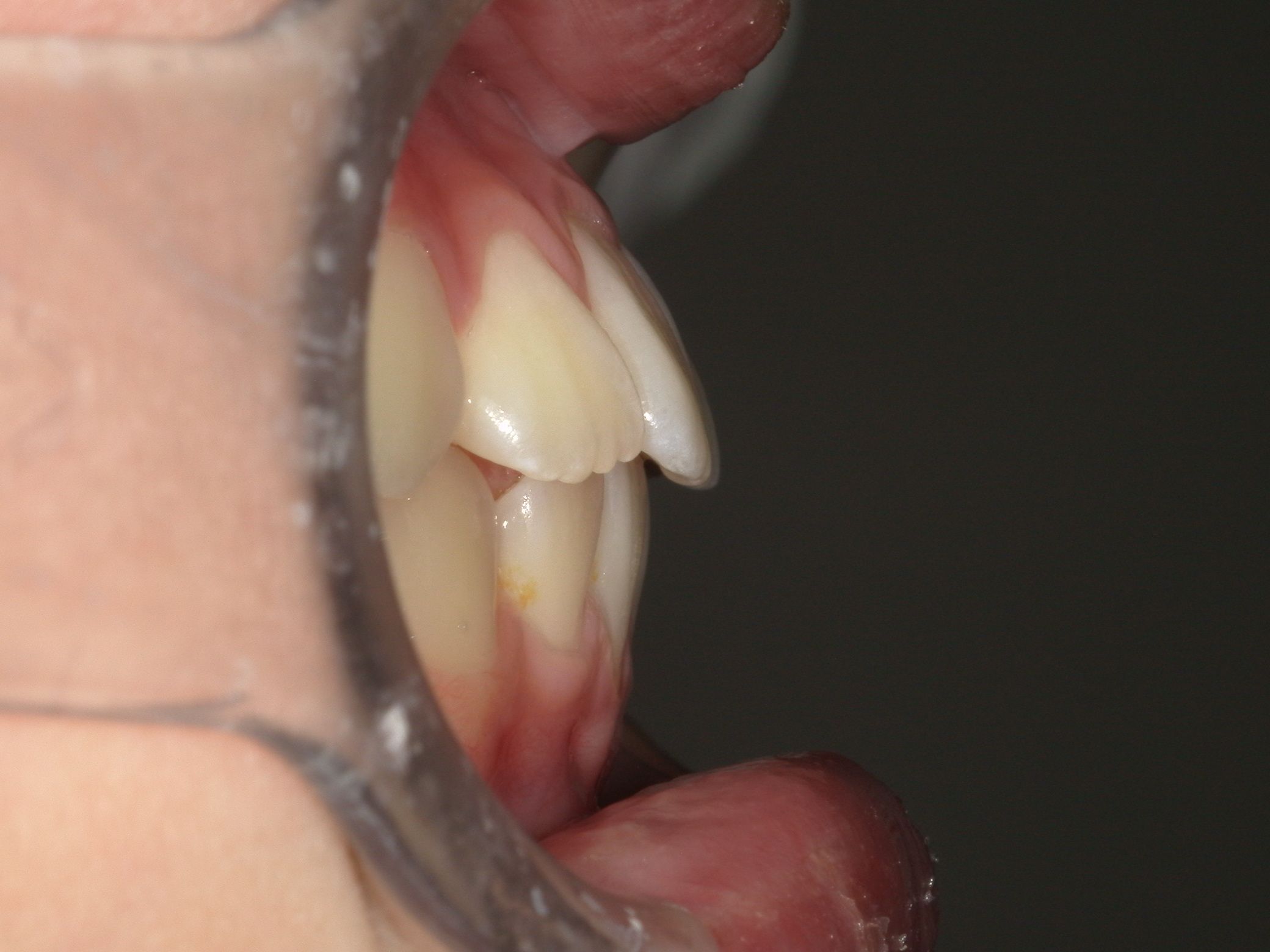 上顎下顎共に前方へ成長された。