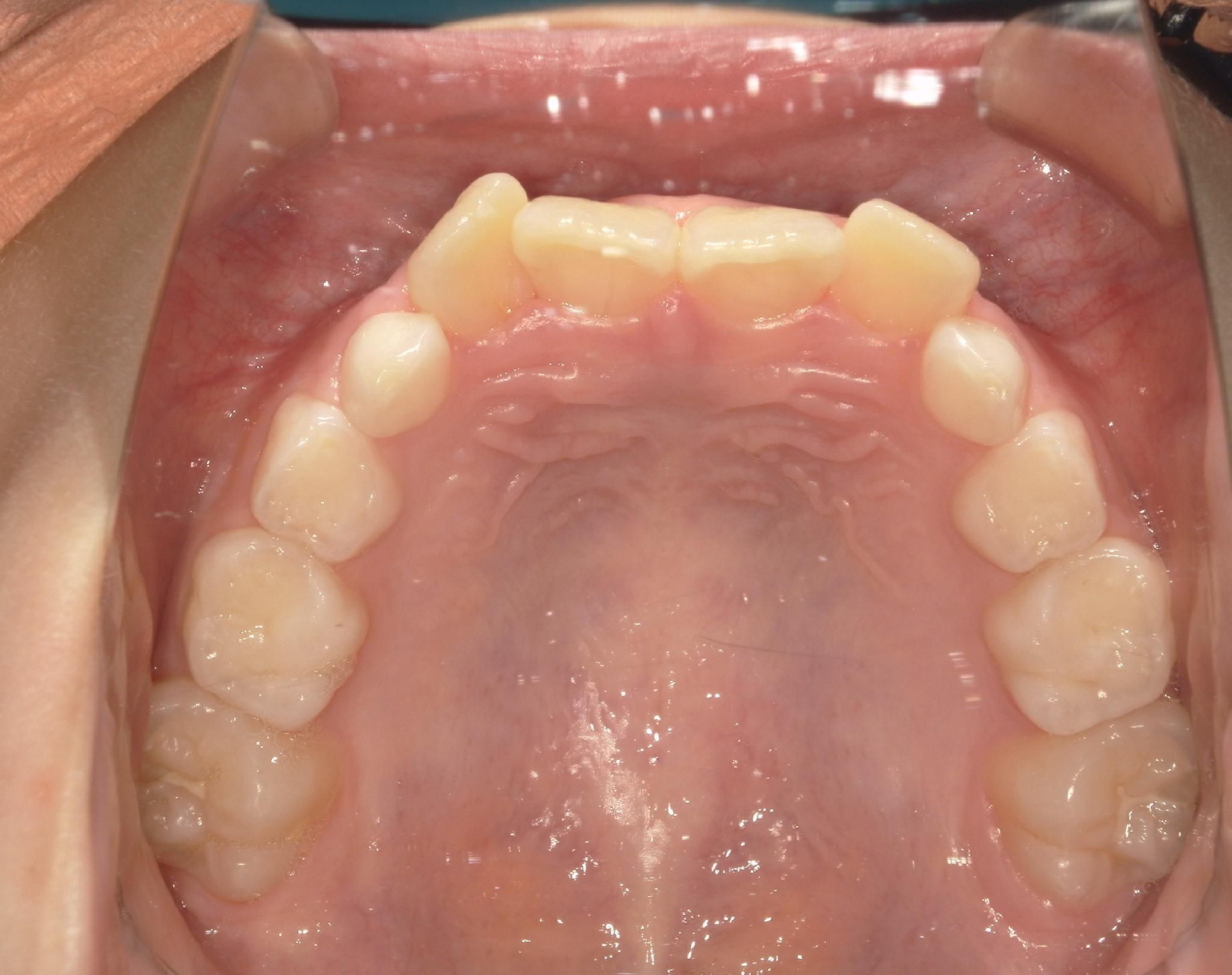 前歯ががたついており、歯列が四角気味になっている。