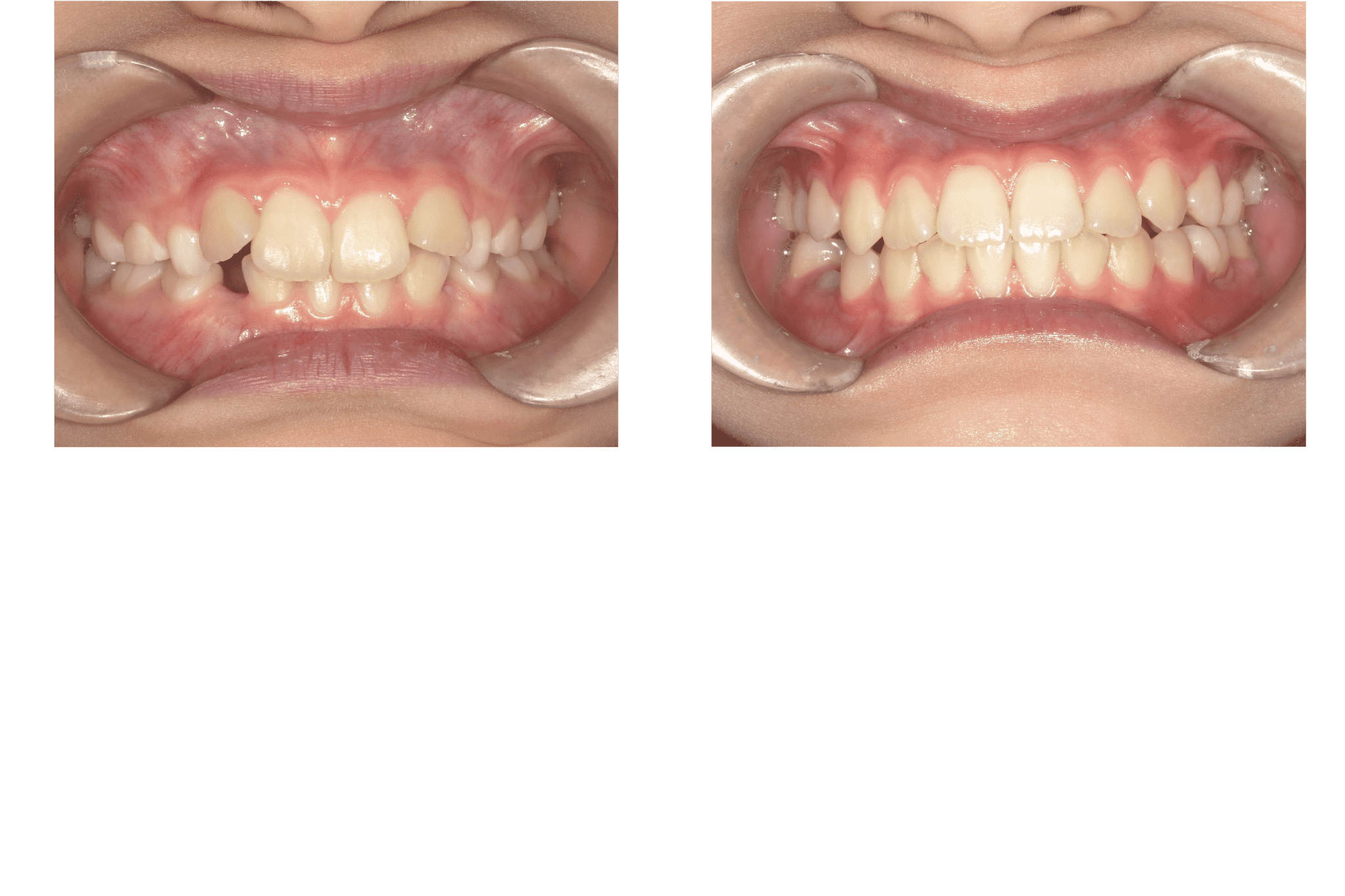 前歯のがたつきと四角い歯列が大変身！