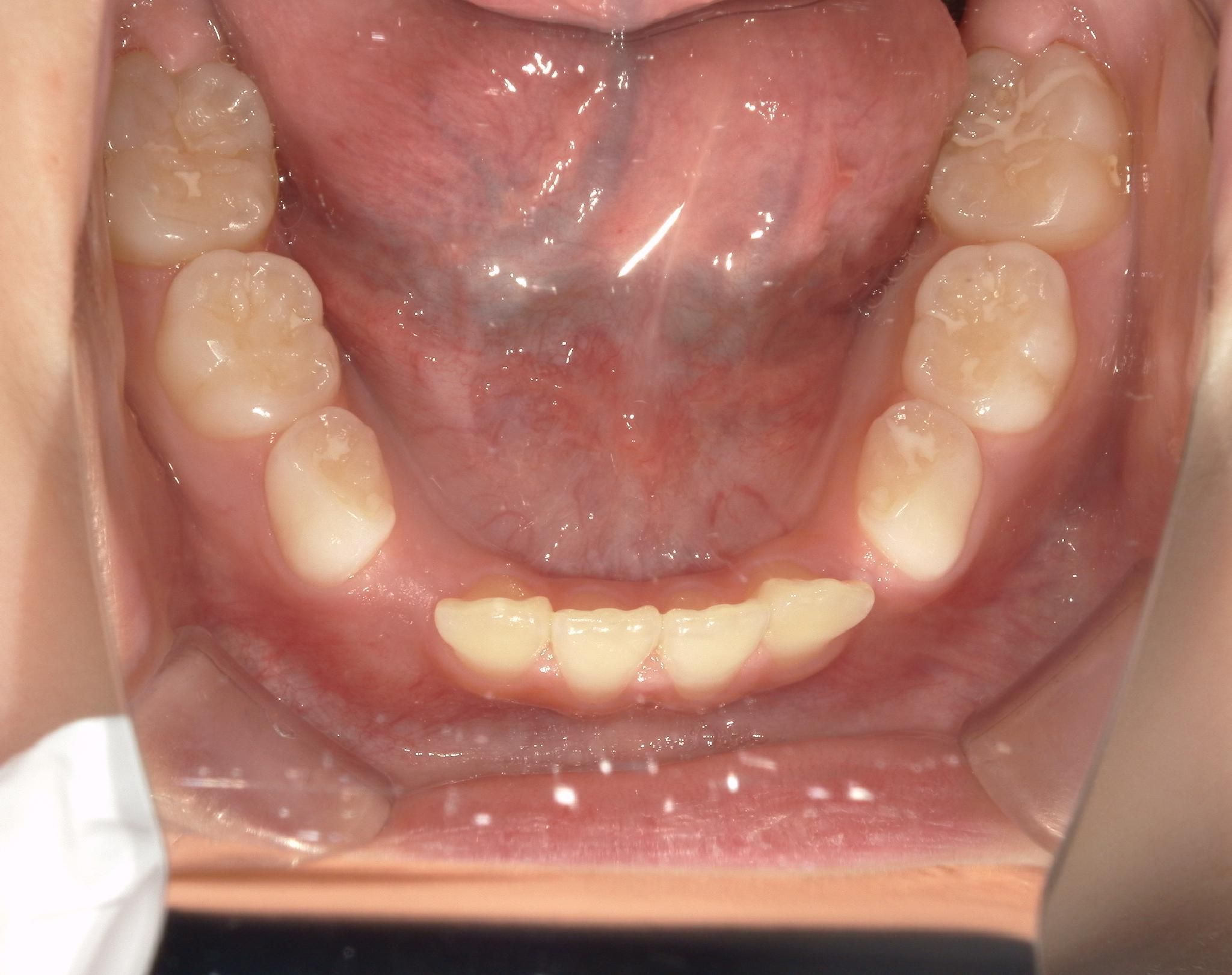 スペース不足で永久歯が入らなさそう。