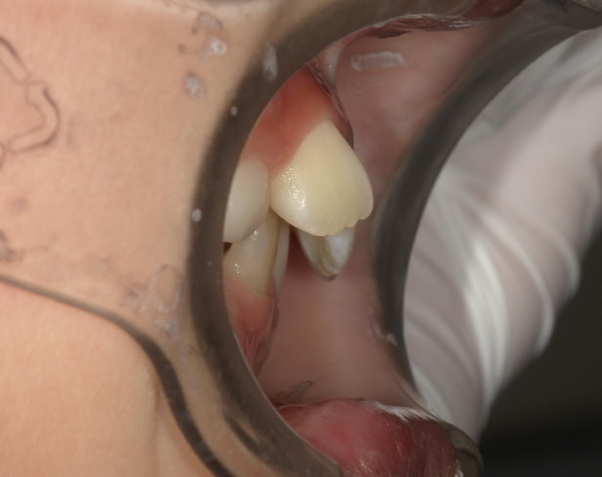 出っ歯になっている。