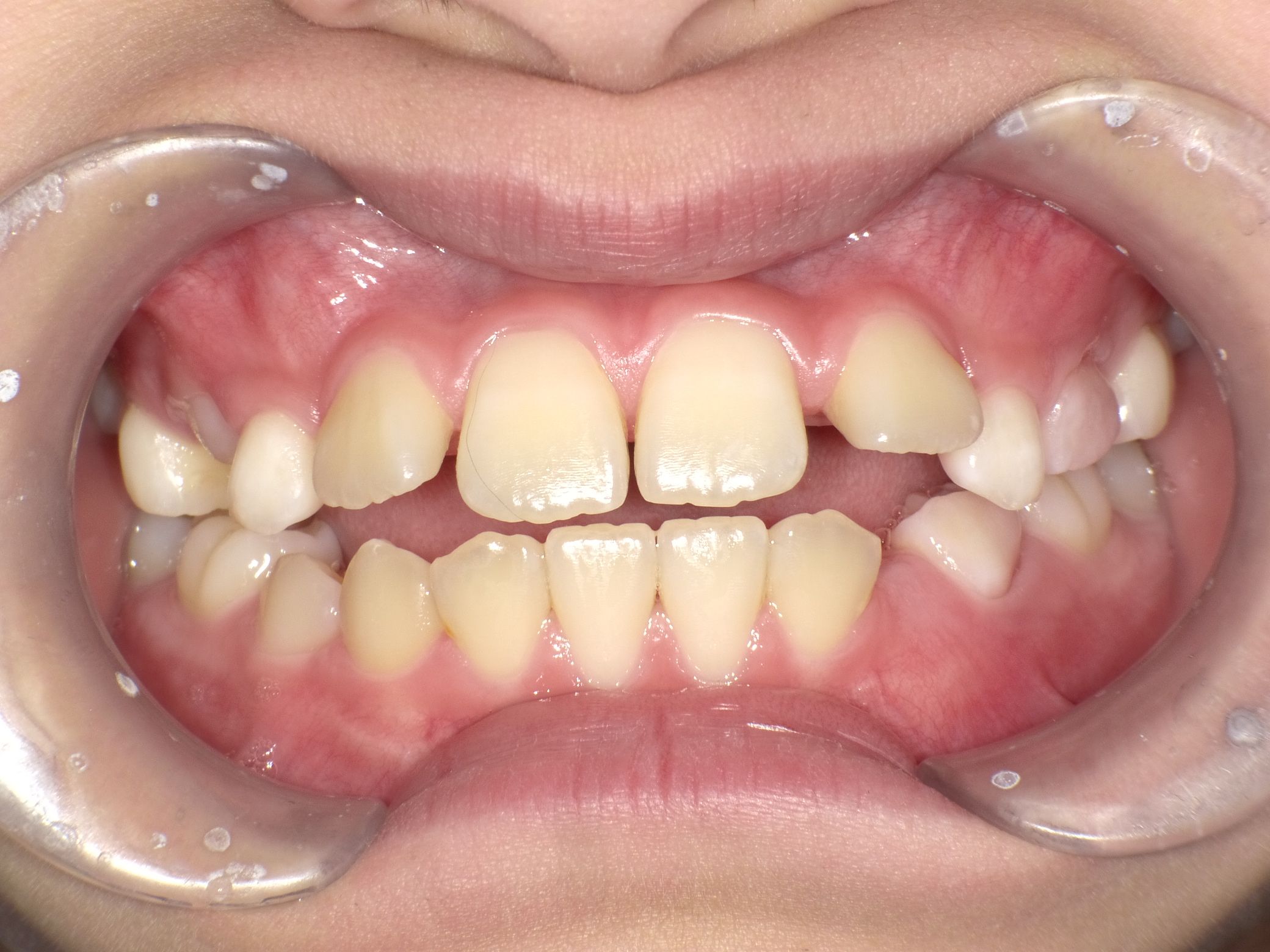 前歯のがたつきと四角い歯列が大変身！