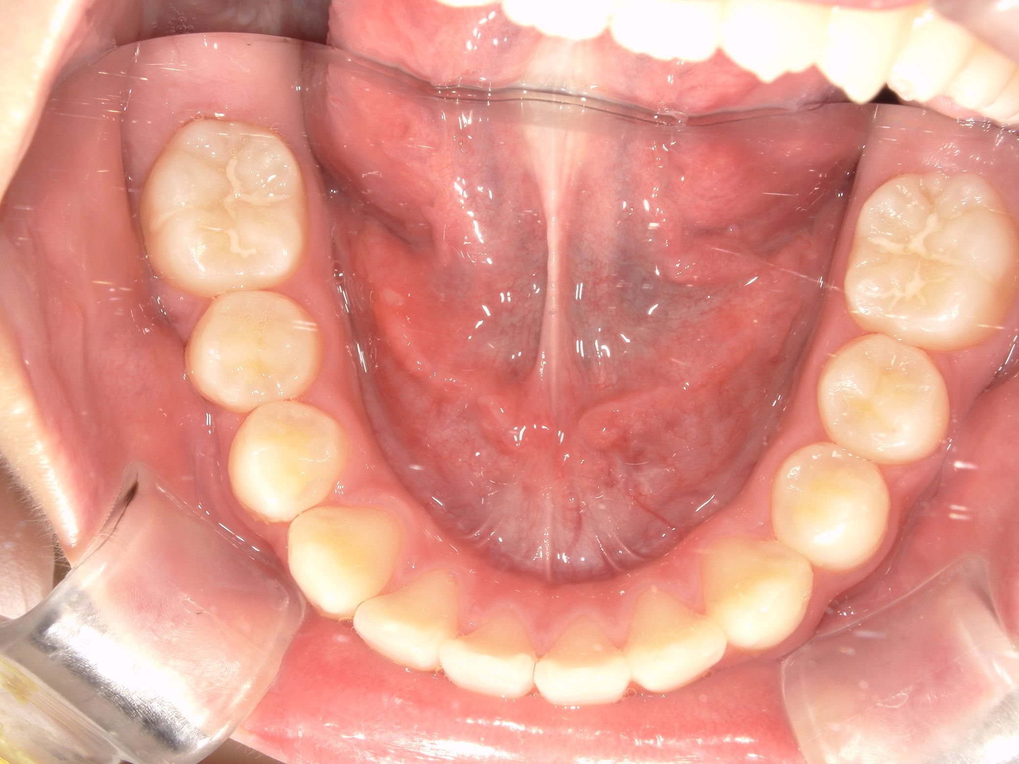 BWSにより新しく生えてきた永久歯のスペースも確保し、すべての歯がきれいに並びました