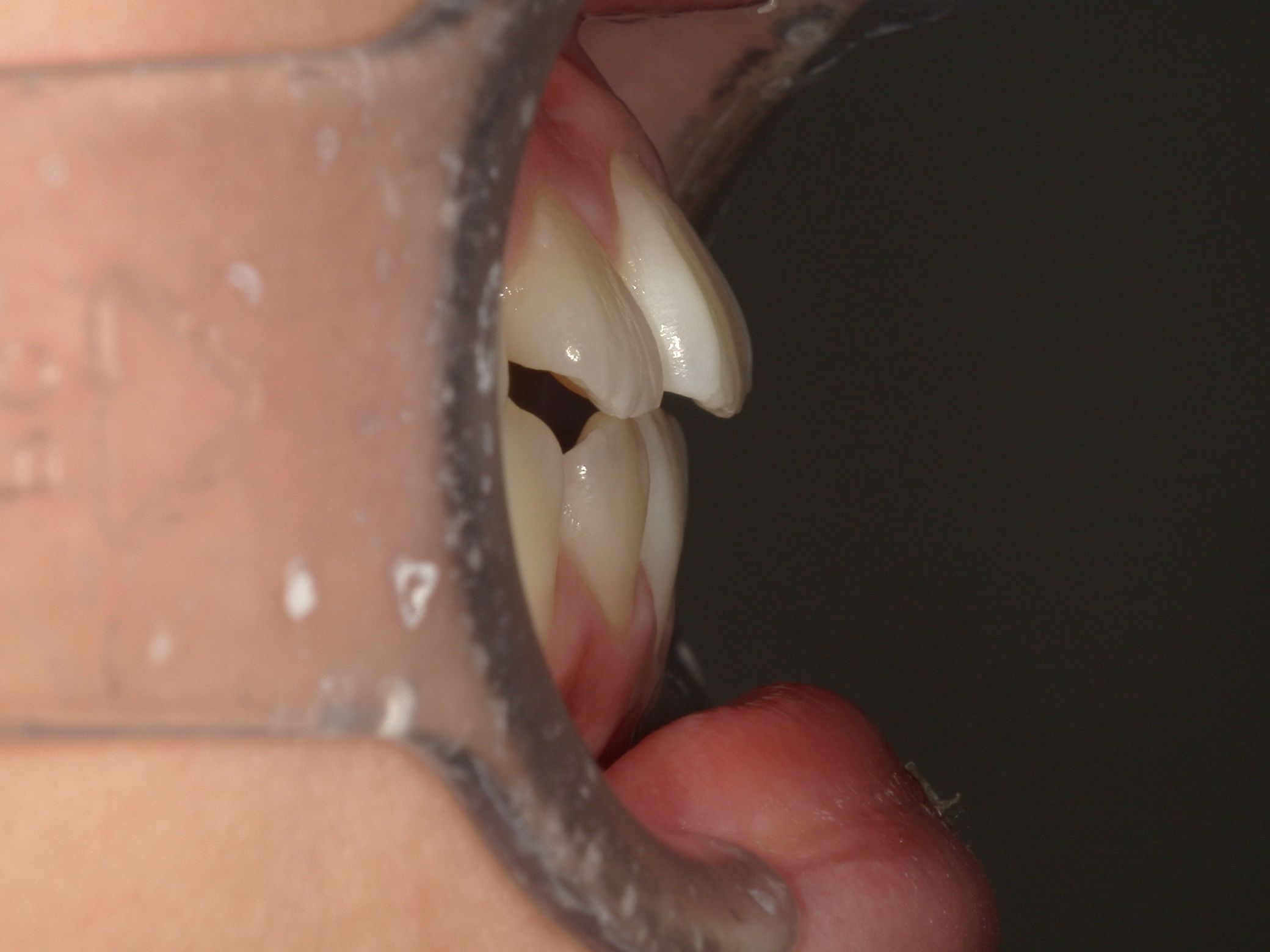 下顎が前方に成長し、出っ歯が改善されました