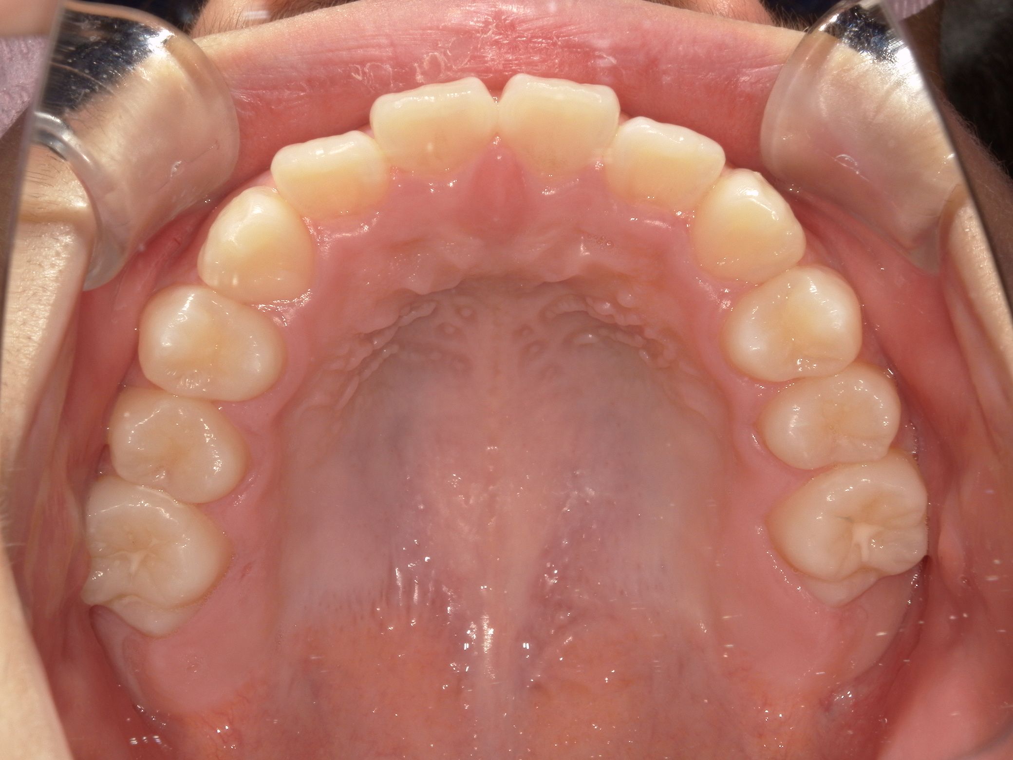 ガタガタ歯並びがきれいに並び、出っ歯も改善！test
