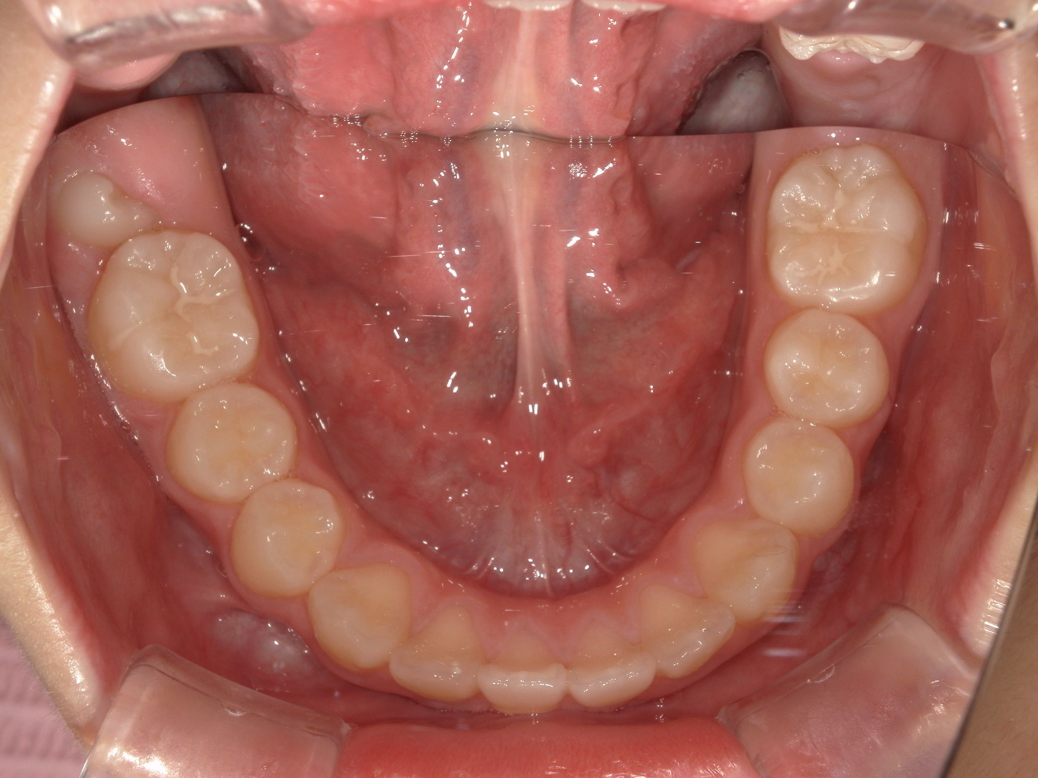 終了後もきれいなアーチを保っています
