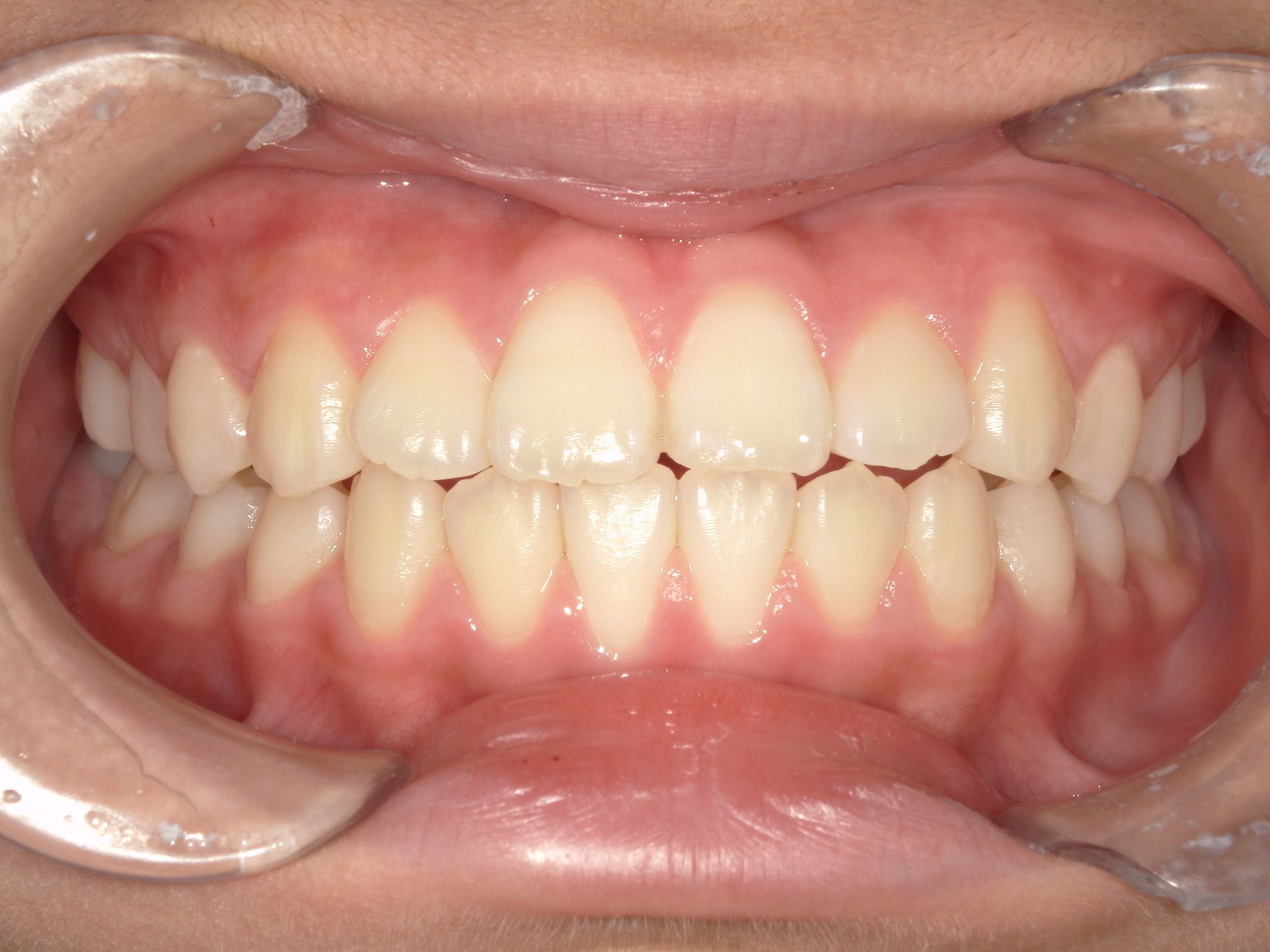 夜間のマウスピースをしっかり使うことで、しっかり前歯も閉じました