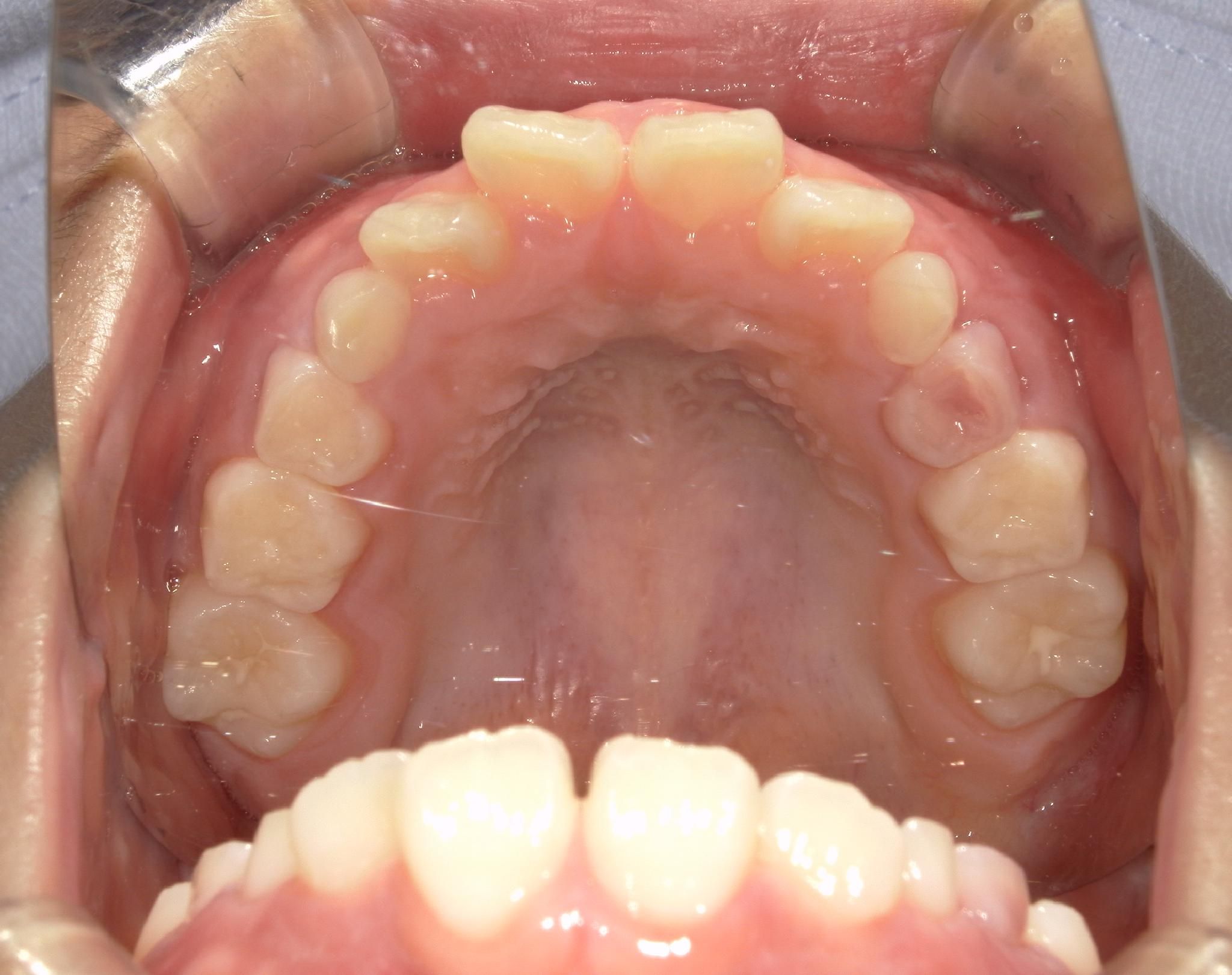 ガタガタ歯並びがきれいに並び、出っ歯も改善！test
