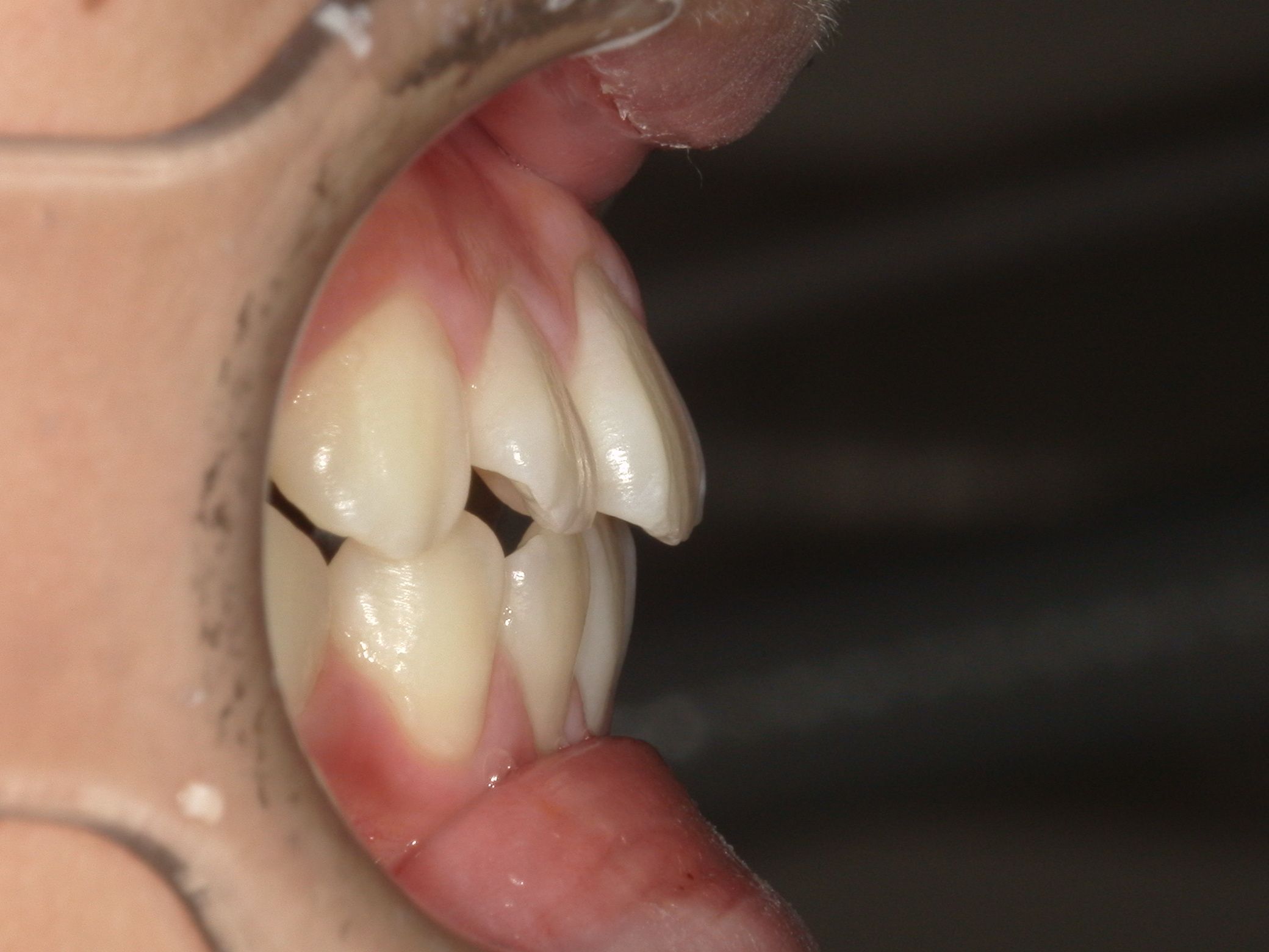 下顎が前方に成長し、出っ歯が改善されました