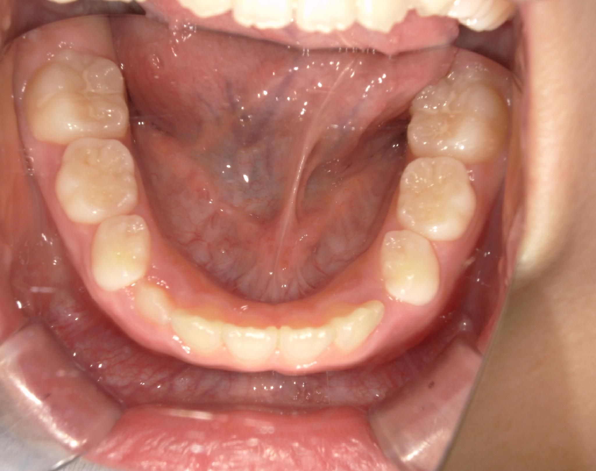 すき間がなく、新しく生えてくる永久歯のスペースが足りていません