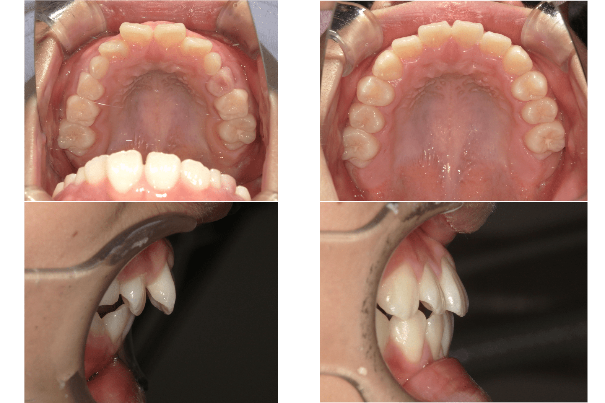 ガタガタ歯並びがきれいに並び、出っ歯も改善！test