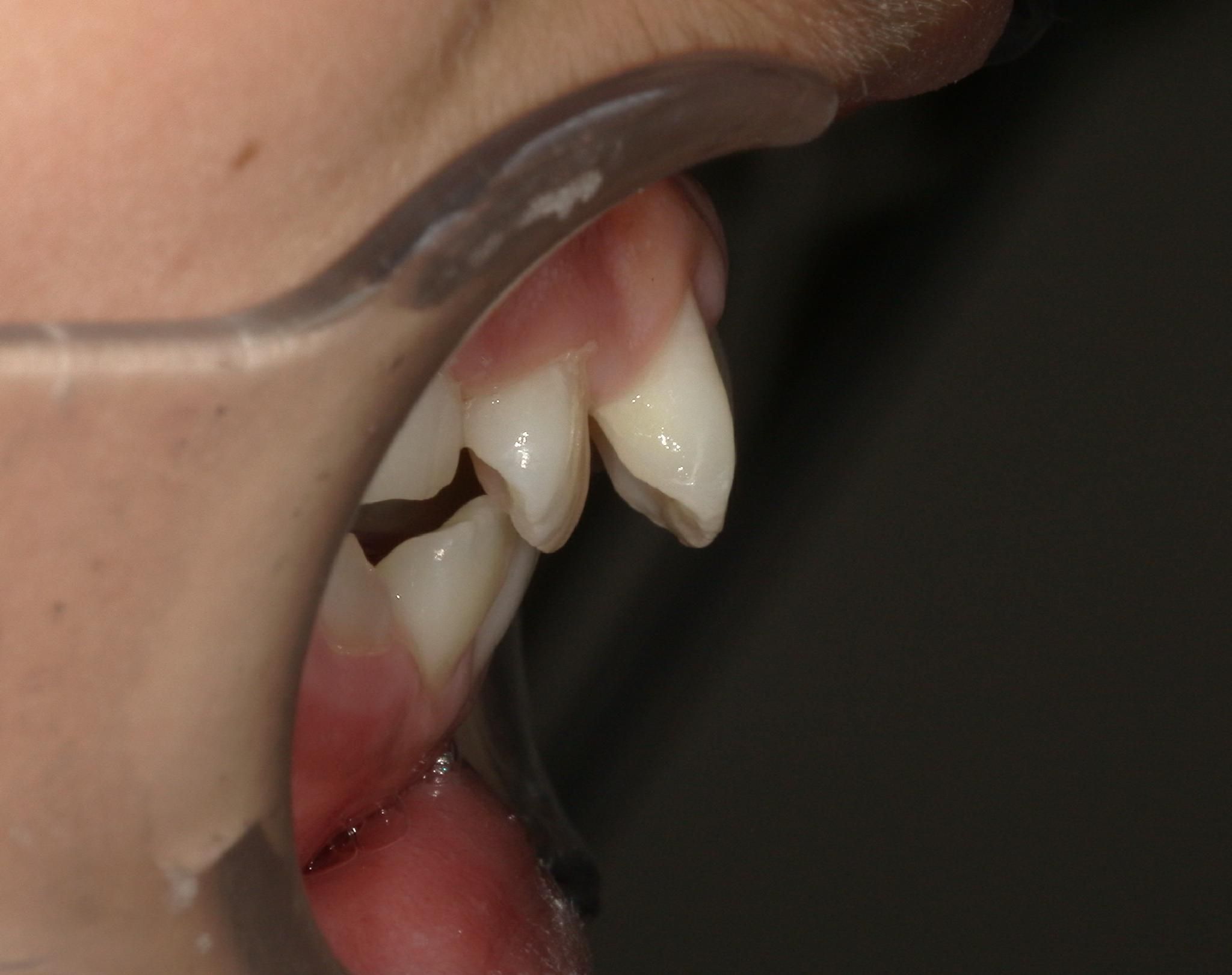 下顎が十分に成長せず、出っ歯の状態です