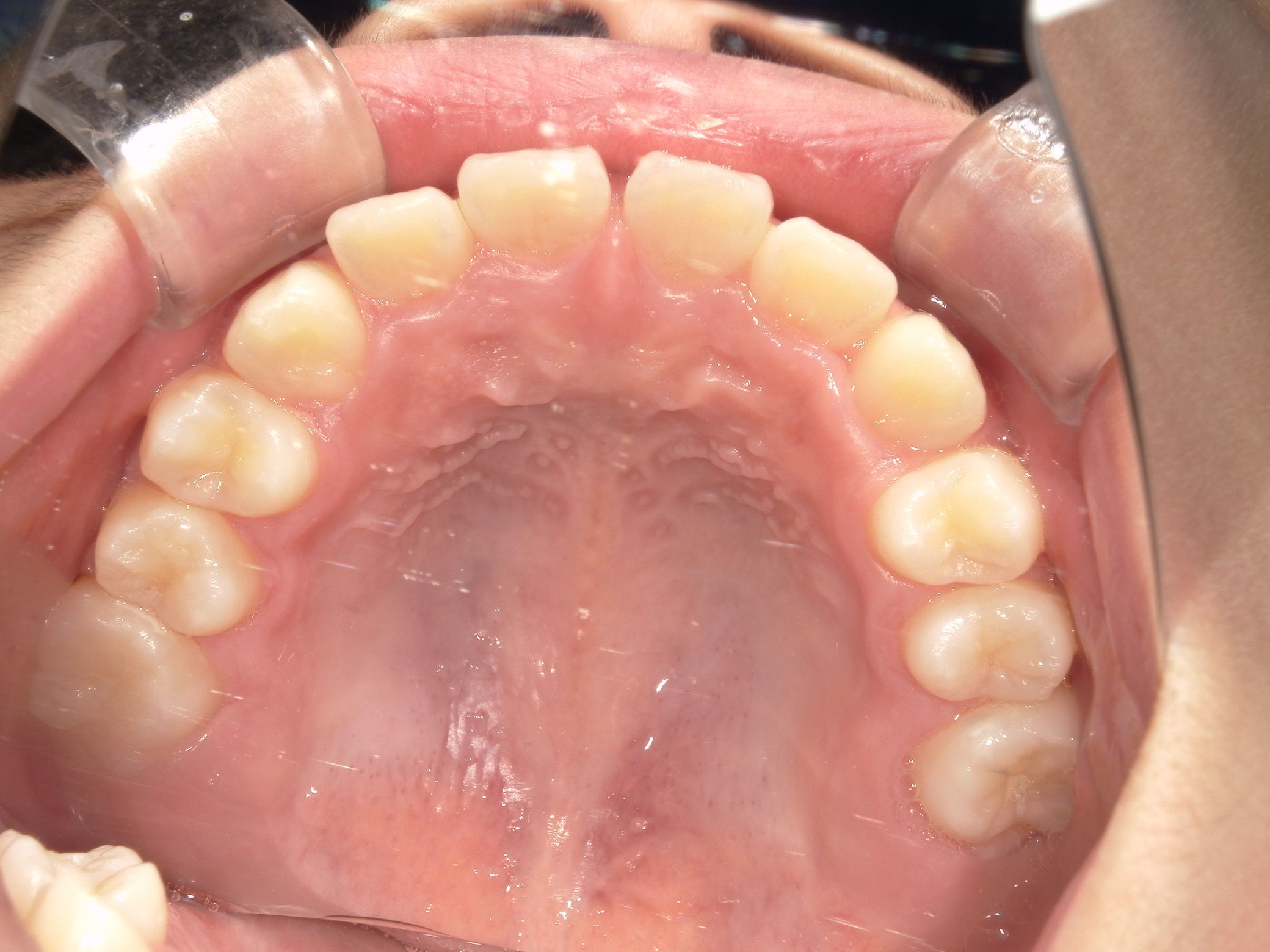 ガタガタ歯並びがきれいに並び、出っ歯も改善！test