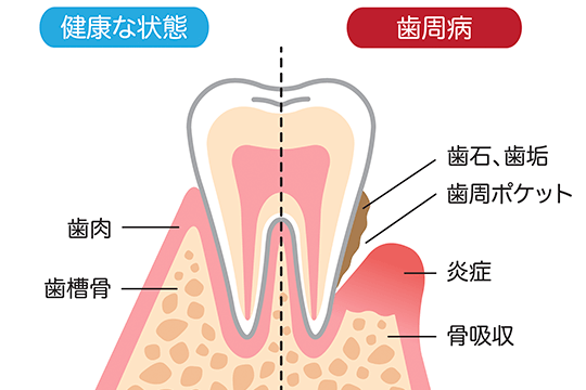 歯周病治療