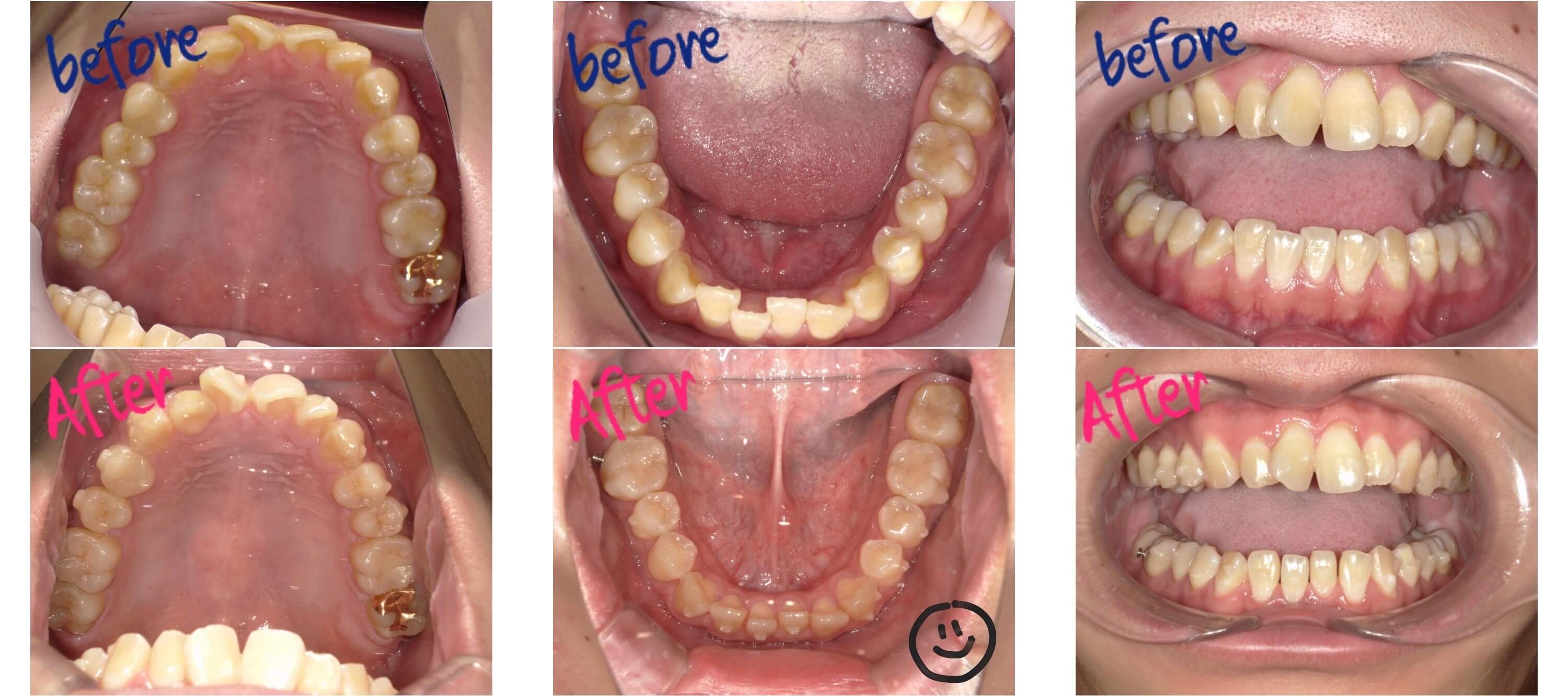 インビザラインで歯並びの他にも変わったこと🦷🦷
